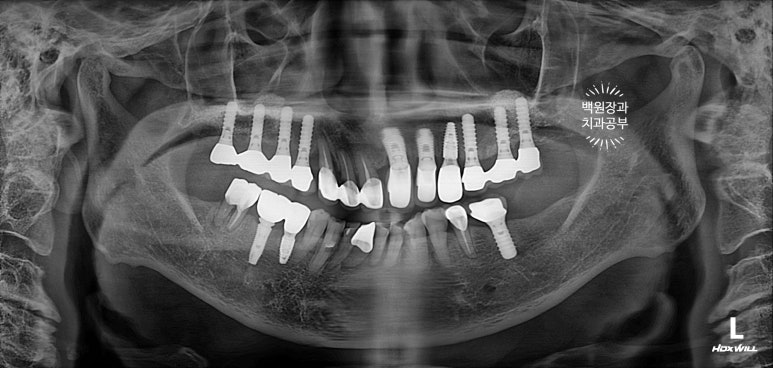 스트라우만 임플란트로 이뽑고 바로심는치과 - 믿고 사용하는 세계 1위 스위스 임플란트 회사. 관련 이미지 26