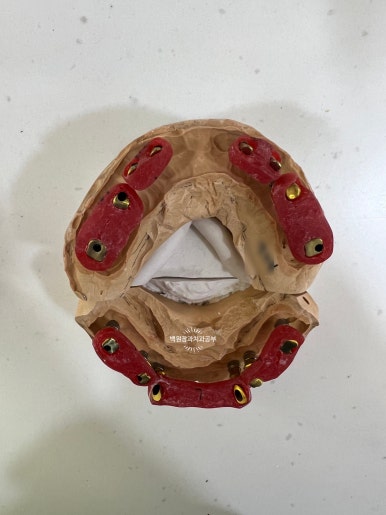 오스템임플란트 네비게이션 전체 임플란트 치료일기. 치료과정/치료기간/비용/솔직후기. 관련 이미지 25