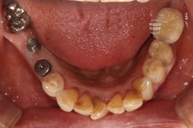 스트라우만 임플란트로 이뽑고 바로심는치과 - 믿고 사용하는 세계 1위 스위스 임플란트 회사. 관련 이미지 24