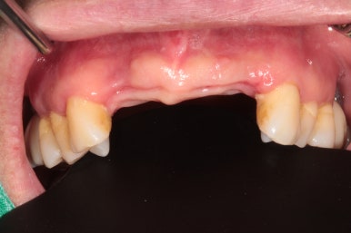 앞니가 풍치로 흔들거려요. 심한 치주염인데 임플란트 가능할까요? 치료과정/치료기간/비용/성공후기. 신금호역 치과 추천. 관련 이미지 16