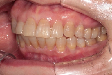 삐뚤어진 앞니를 8개월만에 가지런하게 만드는 50대 성인부분교정. 신사역 교정치과. 치료과정/기간/비용. 관련 이미지 20