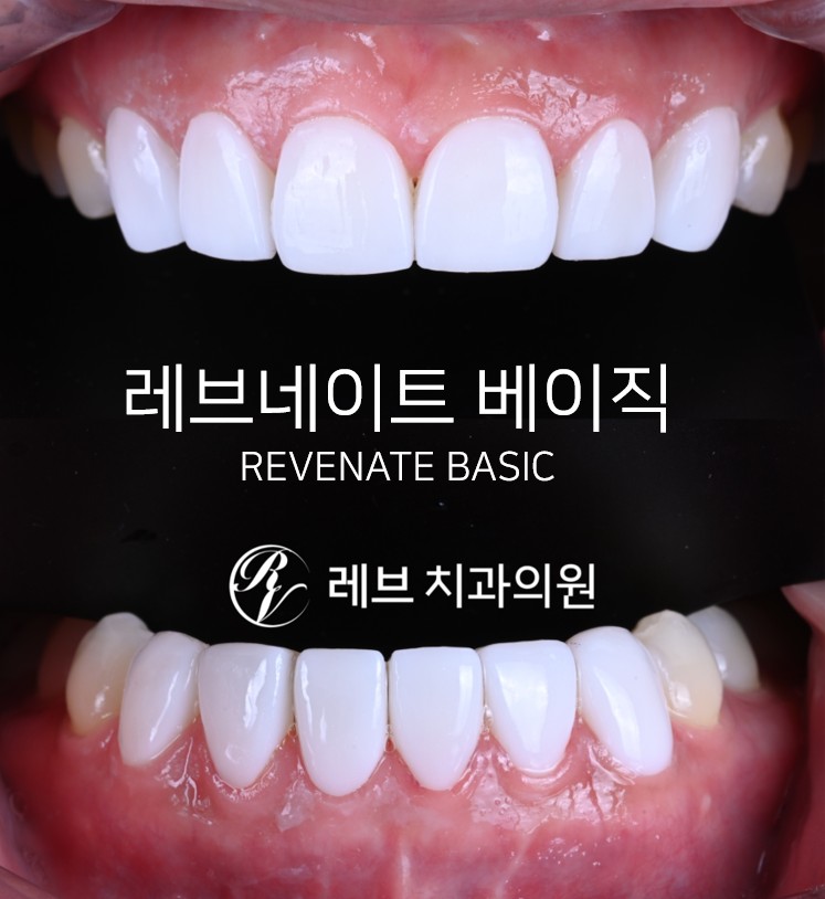레브네이트 베이직. 치아미백과 치아교정을 한번에! 치아삭제 사진 있음. 신사역 치과 앞니라미네이트 모델/비용/후기. 관련 이미지 1