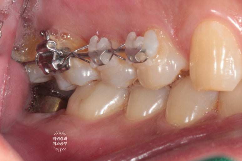 아래 어금니가 없어 위 어금니가 내려왔어요. 부분 교정을 곁들인 스트라우만 임플란트 수술. 억울한 신경치료를 피해보자. 치료과정/치료기간/비용/후기. 관련 이미지 10