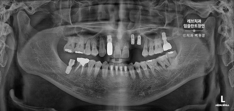 앞니 부러짐? 뽑고 바로 임플란트 + 뼈이식. 앞니 흔들림? 뽑고 1달 기다리고 임플란트 + 뼈이식. 신사역 치과 후기/비용/과정. 관련 이미지 16