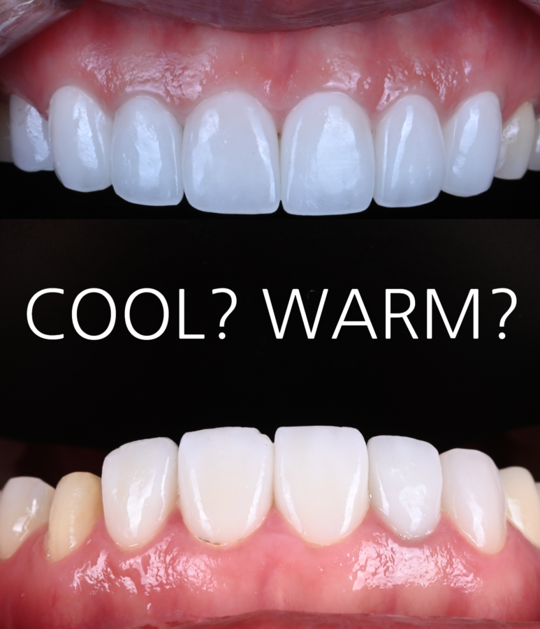 신사역 퍼스널컬러 맞춤 치과. 전담 세라미스트가 앞니 크라운과 라미네이트를 만들어 드립니다. 관련 이미지 1