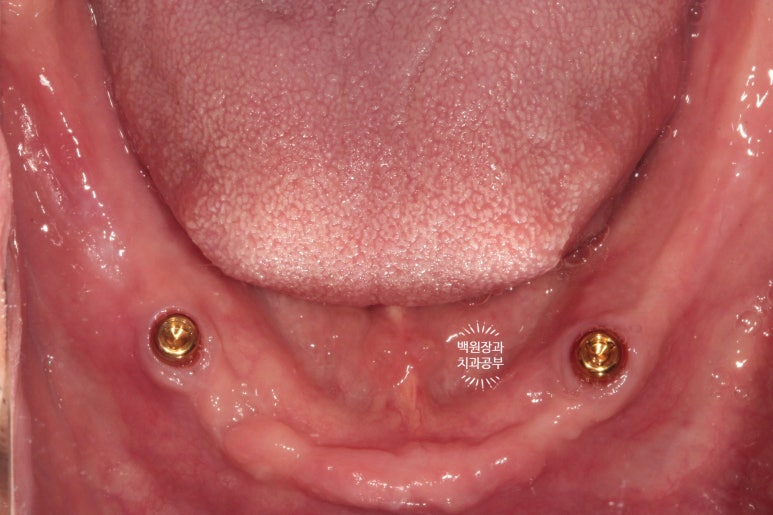 임플란트틀니 - 오버덴쳐. 오스템BA임플란트 이용한 최고의 가성비 치료. 치료과정/치료기간/비용/후기. 관련 이미지 12