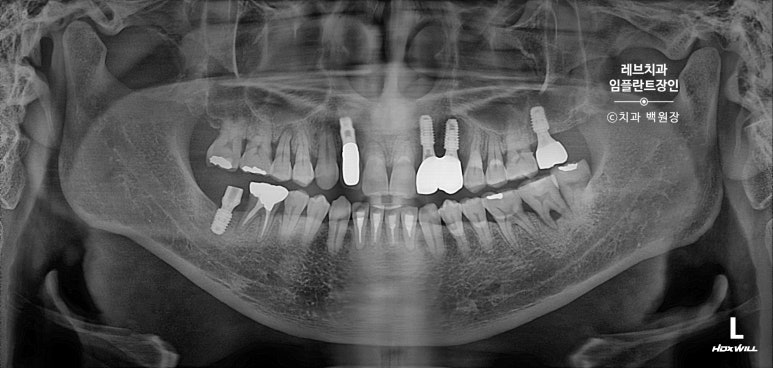 앞니 부러짐? 뽑고 바로 임플란트 + 뼈이식. 앞니 흔들림? 뽑고 1달 기다리고 임플란트 + 뼈이식. 신사역 치과 후기/비용/과정. 관련 이미지 19