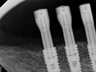 부분틀니를 오래써서 어금니가 아플 때, 아래턱 양쪽 어금니 임플란트 잘하는 강남임플란트치과 관련 이미지 17