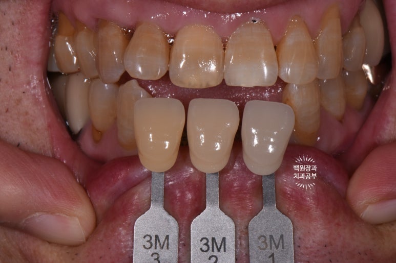 Seoul Sinsa Station [Lev Dental Clinic] For chronic periodontitis, extract the lower front teeth and make the crown look even more real than the real thing with an implant. image 9