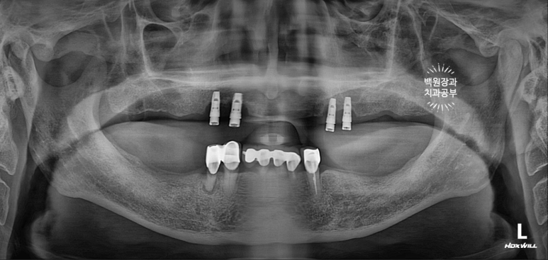 임플란트에서 고름이 나와요. 임플란트 주위염 그리고 재수술을 위한 준비. 치료과정/치료기간/비용/후기. 관련 이미지 2