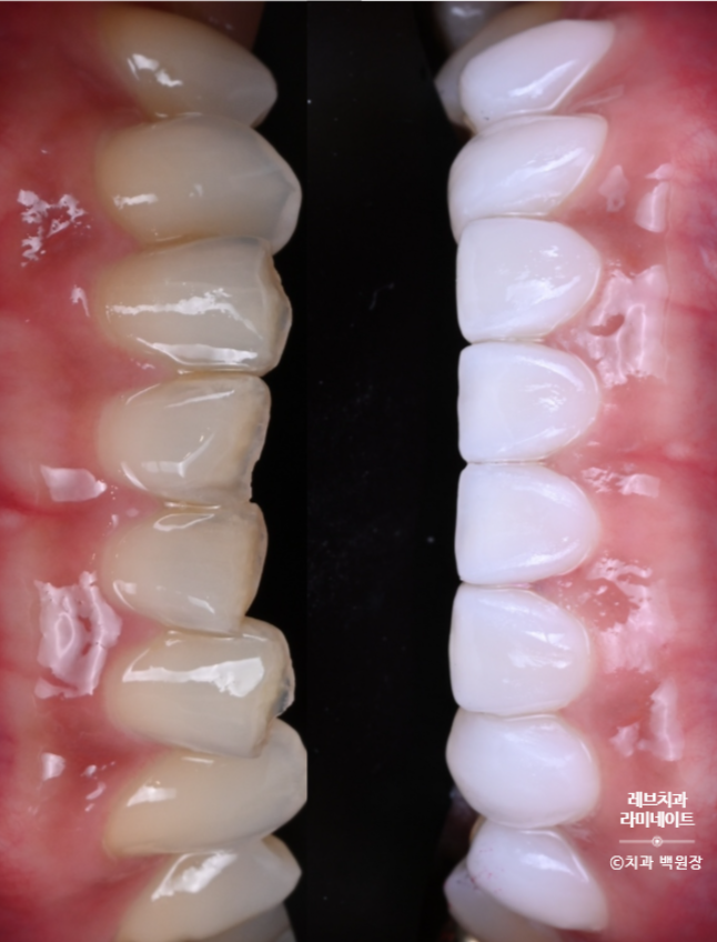 아래앞니 라미네이트도 무삭제로 가능한가요? 레브네이트 베이직 가격/비용/후기/추천. 관련 이미지 18