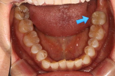 치아크랙 (금간 치아)의 찌릿한 통증 - 발치하지 않고 살려보기. 원인/진단/치료과정/비용/기간. 보존과전문의 치과. 관련 이미지 13