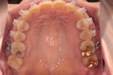 삐뚤어진 앞니를 8개월만에 가지런하게 만드는 50대 성인부분교정. 신사역 교정치과. 치료과정/기간/비용. 관련 이미지 13