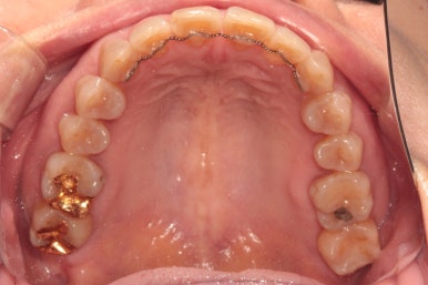 삐뚤어진 앞니를 8개월만에 가지런하게 만드는 50대 성인부분교정. 신사역 교정치과. 치료과정/기간/비용. 관련 이미지 21