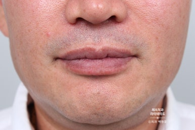 신사역 무삭제 라미네이트 : 레브네이트 내츄럴 최소삭제 비니어. 50대 앞니 벌어짐 비용/후기/얼굴사진. 관련 이미지 5