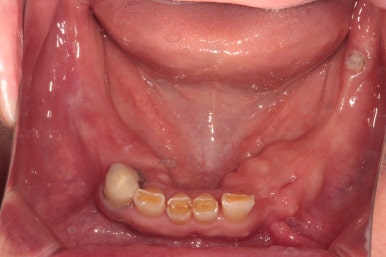 어금니 여러개가 없어요. 전체 임플란트와 앞니 크라운을 통한 완벽한 재건!! 치료과정/치료기간/비용/후기. 관련 이미지 6
