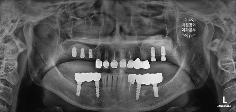 부분틀니 대신 어금니 임플란트를 만들어드립니다. 40대 어금니 상악동 뼈이식 임플란트. 치료기간/비용/과정. 관련 이미지 18