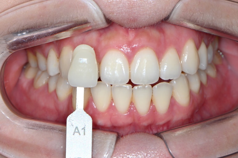 옆면 어금니 충치 하루만에 가능한 논현동 치과. 치아미백 가격 후기. 관련 이미지 3