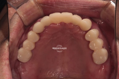 오스템임플란트 네비게이션 전체 임플란트 치료일기. 치료과정/치료기간/비용/솔직후기. 관련 이미지 32