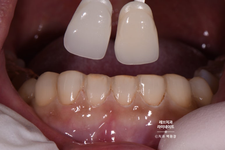 아래앞니 라미네이트도 무삭제로 가능한가요? 레브네이트 베이직 가격/비용/후기/추천. 관련 이미지 8