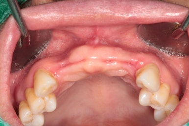 앞니가 풍치로 흔들거려요. 심한 치주염인데 임플란트 가능할까요? 치료과정/치료기간/비용/성공후기. 신금호역 치과 추천. 관련 이미지 17