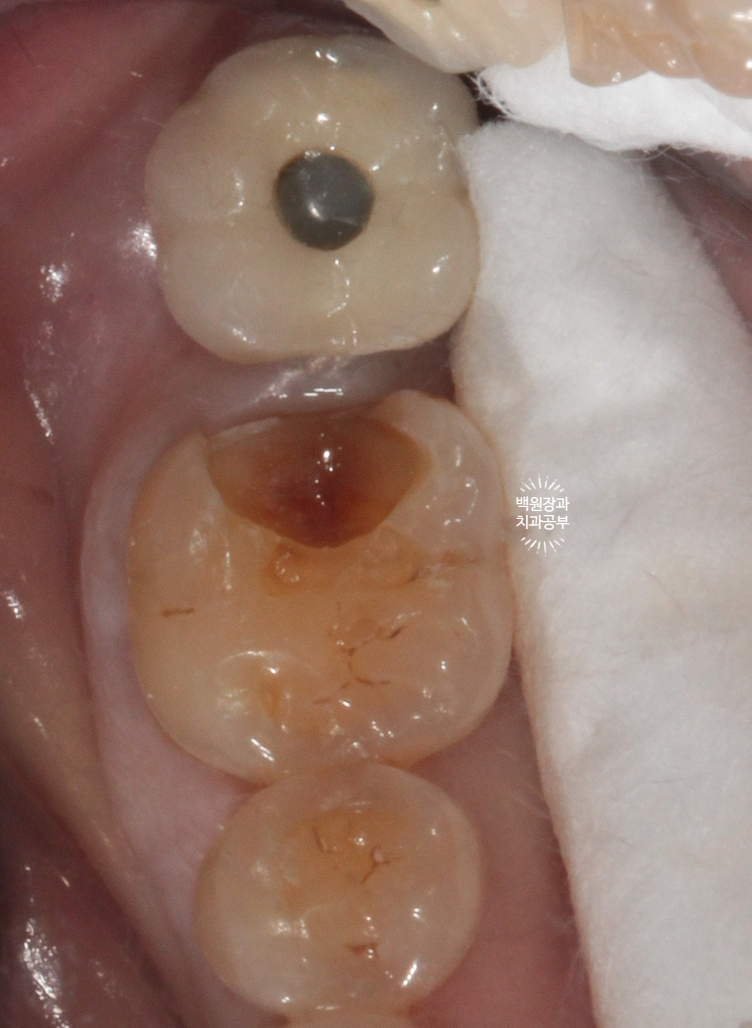어금니 보철물이 떨어졌어요. 골드인레이 탈락 후 지르코니아 크라운으로 치료. 충치치료과정/치료기간/비용/후기. 관련 이미지 5