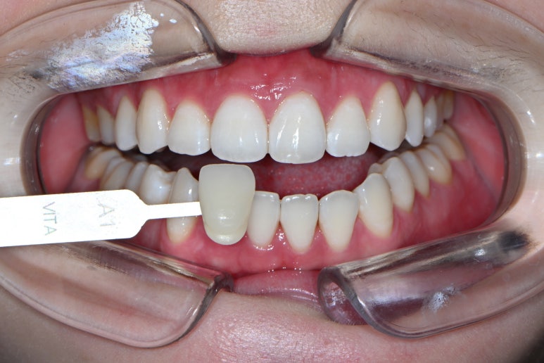 옆면 어금니 충치 하루만에 가능한 논현동 치과. 치아미백 가격 후기. 관련 이미지 5