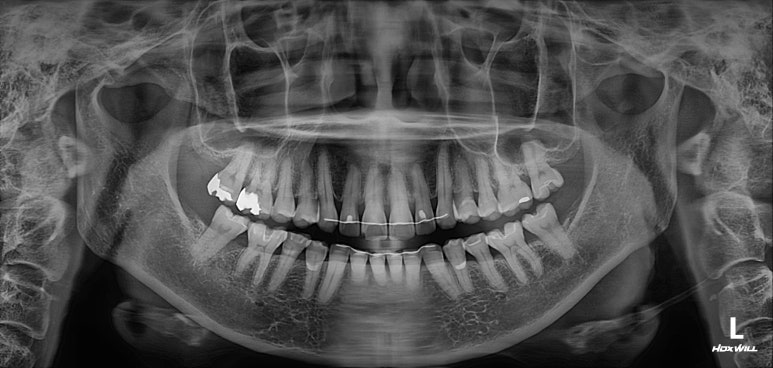 삐뚤어진 앞니를 8개월만에 가지런하게 만드는 50대 성인부분교정. 신사역 교정치과. 치료과정/기간/비용. 관련 이미지 25