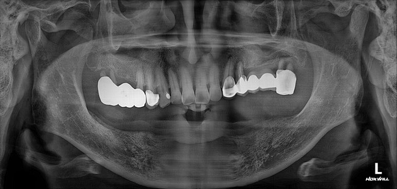 아래 어금니 임플란트 6개면 틀니를 안써도 됩니다.  치주염 전문 착한치과. 치료기간/임시치아과정/후기/비용. 관련 이미지 30