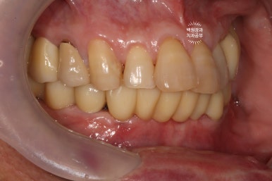 아래 어금니 임플란트 6개면 틀니를 안써도 됩니다.  치주염 전문 착한치과. 치료기간/임시치아과정/후기/비용. 관련 이미지 25