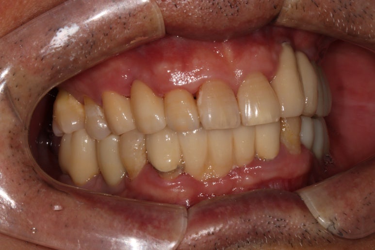 치주염 앞니 잇몸 염증으로 흔들릴 때 - 앞니 브릿지와 임플란트 장단점, 비용. 치료과정과 결과를 눈으로 보여주는 치과. 관련 이미지 14