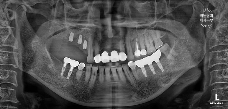 60대 임플란트 주변에서 고름이 나와요. 실패한 임플란트 제거 후 재수술. 덴티움 뼈이식재를 사용한 치조골 이식술. 관련 이미지 10