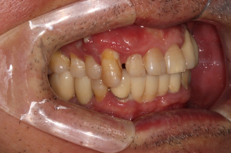 치주염 앞니 잇몸 염증으로 흔들릴 때 - 앞니 브릿지와 임플란트 장단점, 비용. 치료과정과 결과를 눈으로 보여주는 치과. 관련 이미지 7