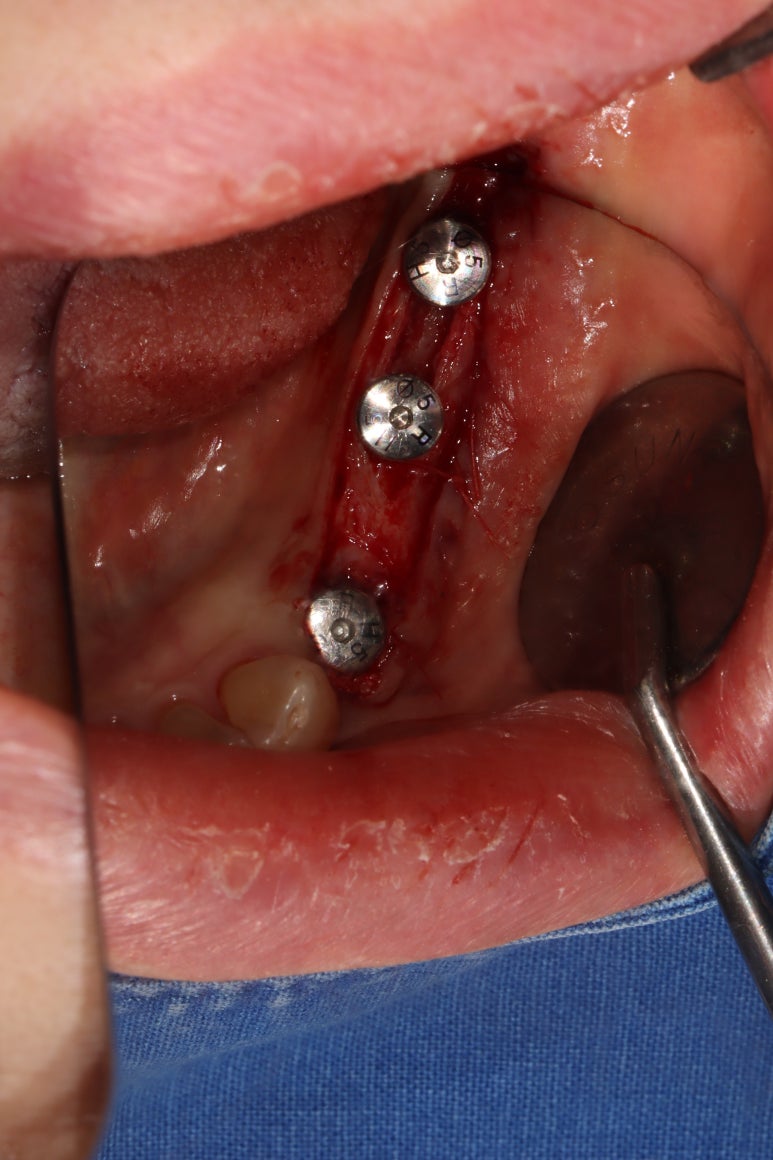 어금니 임플란트 주변 잇몸이식수술 - 저는 해야한다고 생각합니다. (feat. 대한치과의사협회 논문 + 치주과전문) 관련 이미지 19