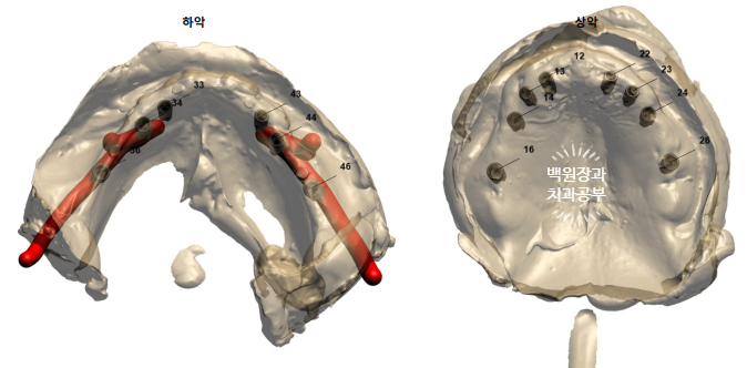 만성치주염으로 인해 아주 좁아진 잇몸뼈에 광범위한 뼈이식 + 전체임플란트. 신사 레브치과. 관련 이미지 12