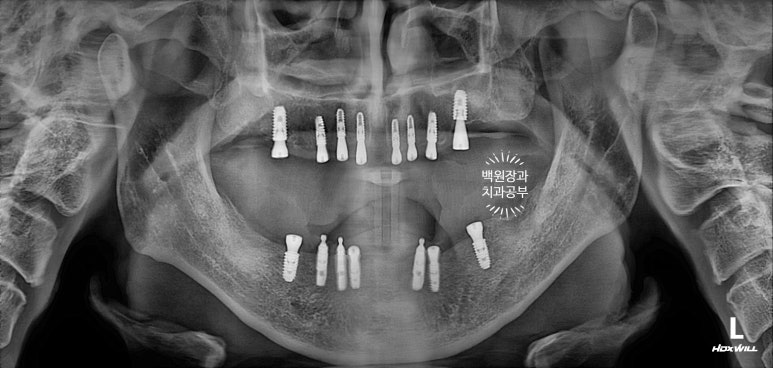 불편한 틀니를 아직도 쓰시나요? 전체 임플란트 치료비용/치료기간/치료과정. 관련 이미지 13