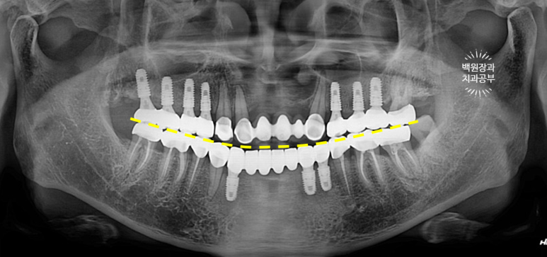 뿌리만 남은 앞니, 어금니가 없어 교합이 무너진 증례. 흡연자의 전체 오스템BA임플란트 재건증례. 치료과정/치료기간/비용/후기. 관련 이미지 31