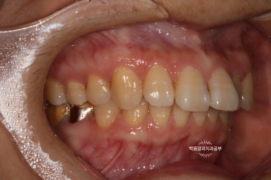 앞니레진치료 할 줄 모르는 치과의사는 없지만, 좋은 레진으로 치료하는 치과의사는 잘 없습니다. 관련 이미지 13