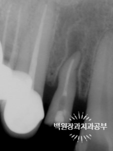 외과적 정출술 (surgical extrusion) - 치아를 살리는 마지막 방법. 치료과정/치료기간/비용/사진. 관련 이미지 12