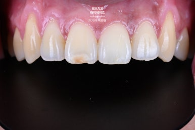 레브네이트 마스터 ; 예비신랑 앞니 무삭제라미네이트. 신사역 치과. 치료후기/비용/가격. 관련 이미지 15
