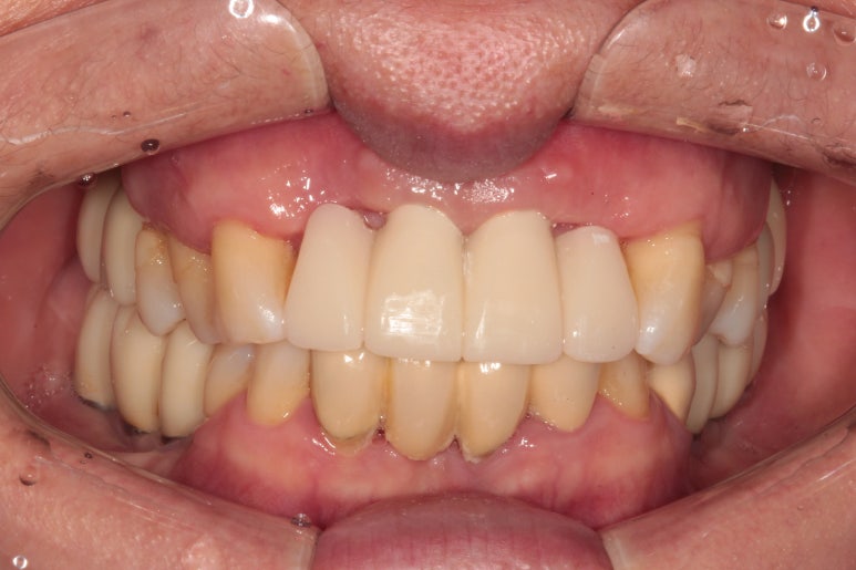 앞니가 풍치로 흔들거려요. 심한 치주염인데 임플란트 가능할까요? 치료과정/치료기간/비용/성공후기. 신금호역 치과 추천. 관련 이미지 29