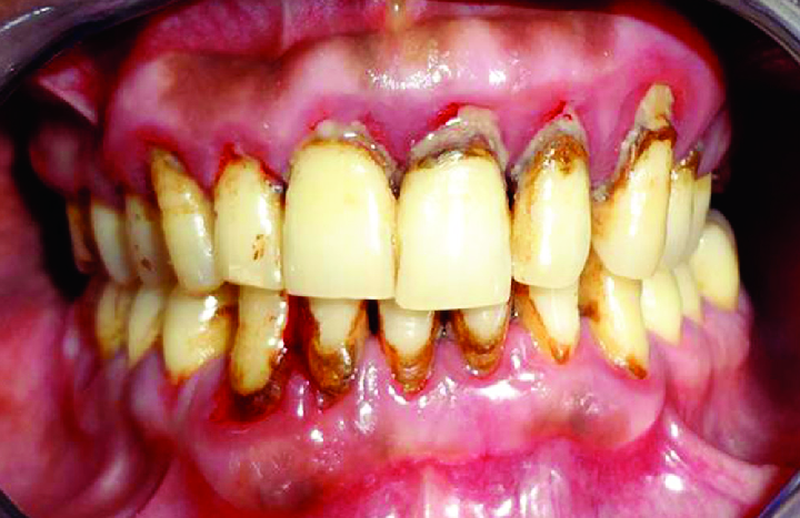 잇몸치료에 대한 모든 것. 치주과 전문의가 설명하는 치주염 치료 비용,과정, 통증, 방법 그리고 치과 실비보험. 관련 이미지 3