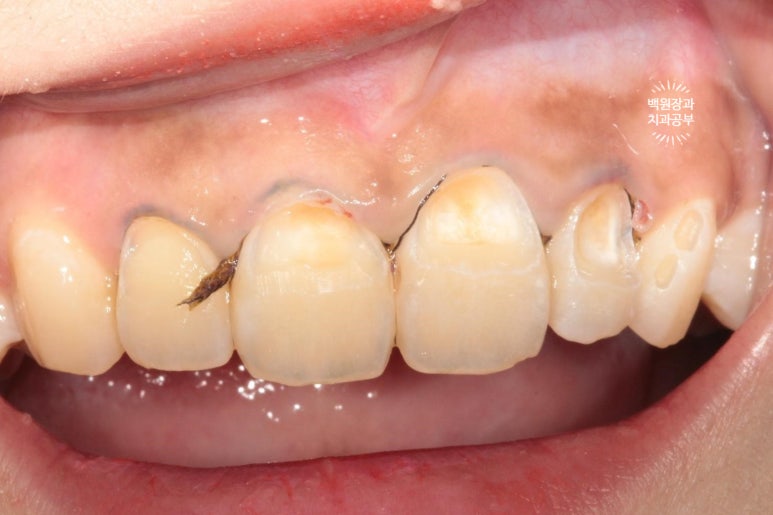 잇몸치료와 앞니 레진치료. 3년이 지난 모습 궁금하지 않으신가요? 3M 레진쓰는 치과. 후기/시간/과정/비용. 관련 이미지 7