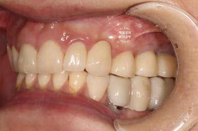 부분틀니 대신 어금니 임플란트를 만들어드립니다. 40대 어금니 상악동 뼈이식 임플란트. 치료기간/비용/과정. 관련 이미지 24