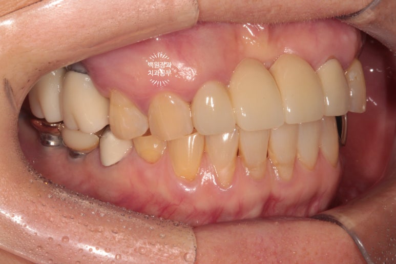 60대 임플란트 주변에서 고름이 나와요. 실패한 임플란트 제거 후 재수술. 덴티움 뼈이식재를 사용한 치조골 이식술. 관련 이미지 20