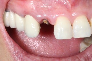 외과적 정출술 (surgical extrusion) - 치아를 살리는 마지막 방법. 치료과정/치료기간/비용/사진. 관련 이미지 16