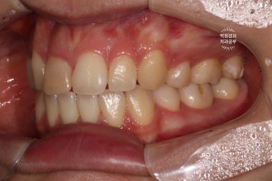 잇몸 성형과 치아미백 그리고 지르코니아 20대 앞니 크라운 치료. 치료과정/기간/비용. 관련 이미지 5
