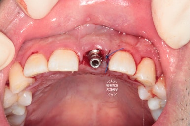 앞니 머리가 기둥째 부러졌어요. 발치 동시 뼈이식 오스템 BA 임플란트. 치료과정/치료기간/비용/후기. 압구정 치과. 관련 이미지 12