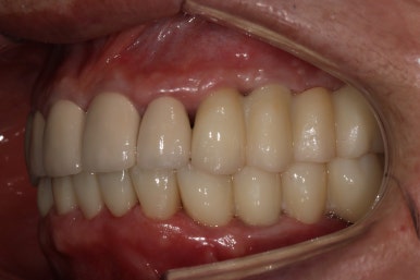 어금니 여러개가 없어요. 전체 임플란트와 앞니 크라운을 통한 완벽한 재건!! 치료과정/치료기간/비용/후기. 관련 이미지 29