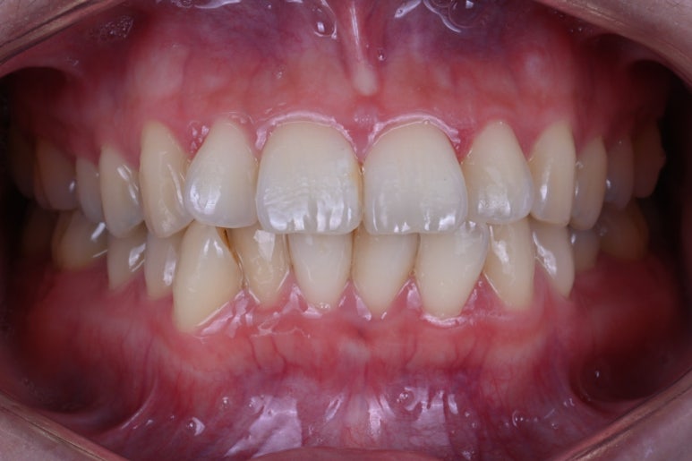 강남 치아미백 성지 레브치과. 가격/비용/부작용/전후사진. 관련 이미지 2